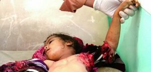 شاهد #هيلة_الطفولة_المبتورة حملة يمنية جديدة تطالب العالم بوقف المجازر السعودية بحق أطفال اليمن