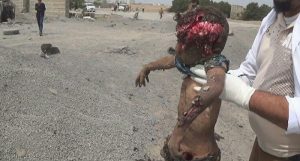 السعودية تجرّب طائرتها الجديدة بمجزرة: 23 قتيلاً وجريحاً بينهم أطفال ونساء من نازحي الحديدة (صور)