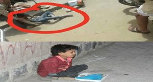 بالصور: أحد ضحايا قصف صنعاء..نهاية حياة بلا وزن لطفل الميزان