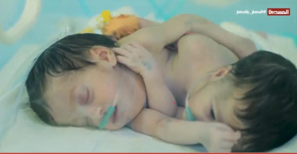 الحصار يمنع علاج توأم سيامي ويضاعف معاناة آلاف المرضى اليمنيين