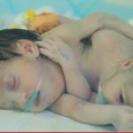 الحصار يمنع علاج توأم سيامي ويضاعف معاناة آلاف المرضى اليمنيين